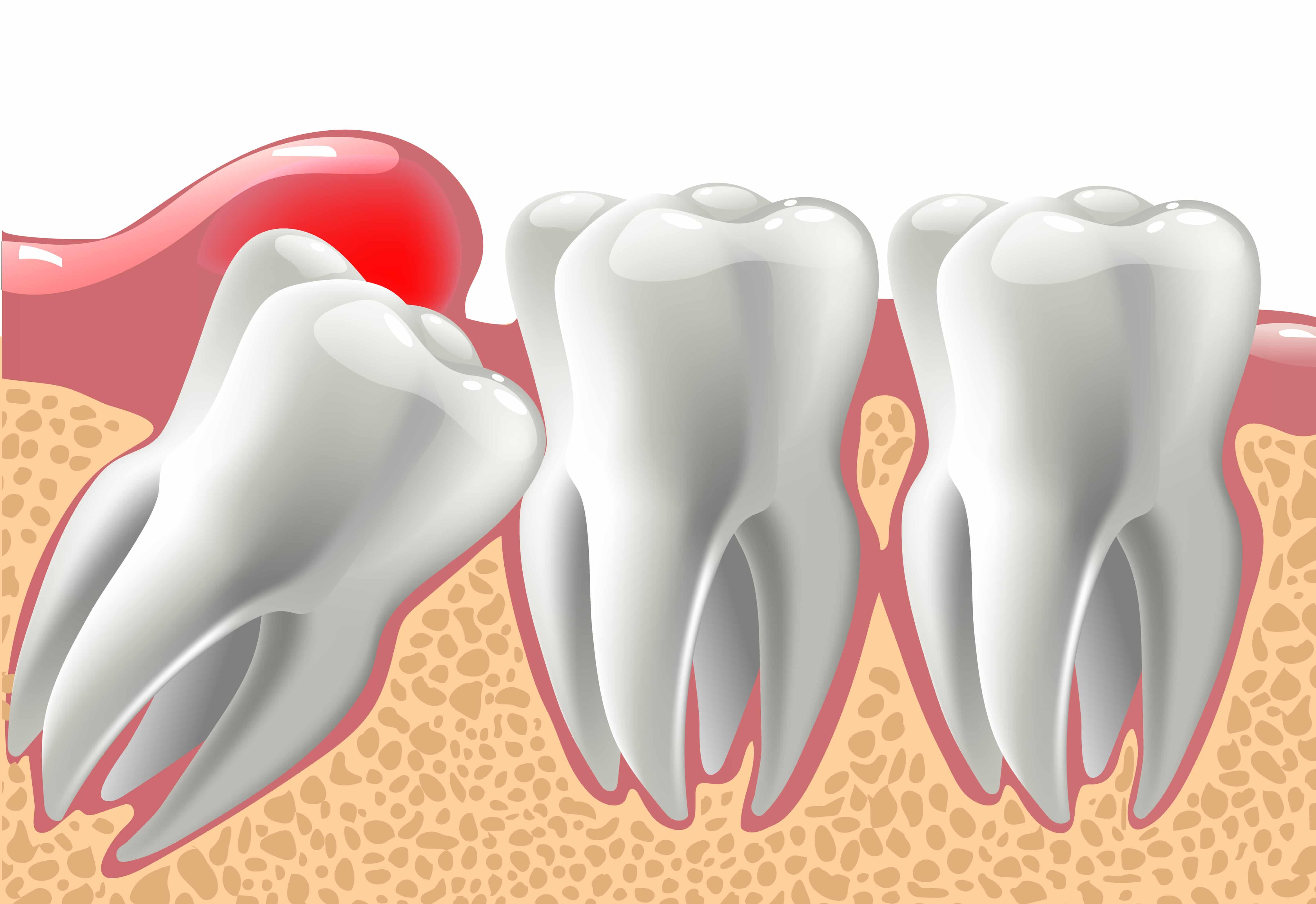 Illustration of an wisdom tooth under the gum line