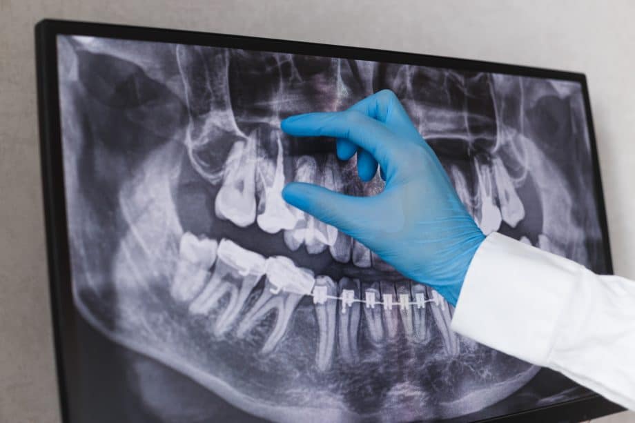 Dentist looks at patients x-ray for Signs of an Oral Surgery Infection in Milwaukee