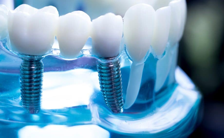 Restorative dental implants available in Milwaukee, WI