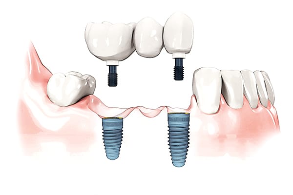 3-unit implant bridge screw retained illustration