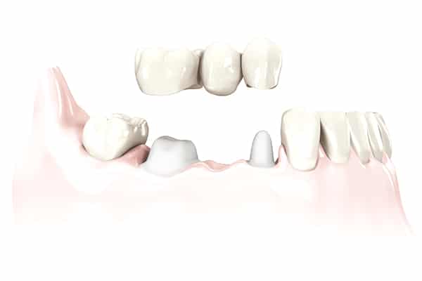 Dental Bridge Illustration