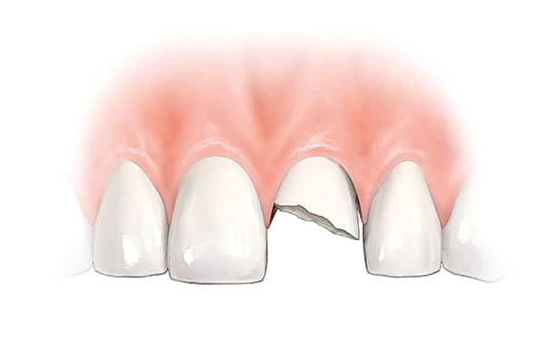 Anterior single tooth broken  illustration