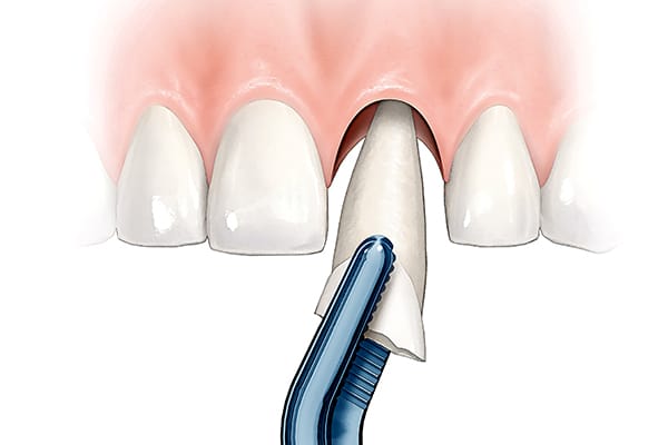 Anterior Single tooth: Extraction illustration