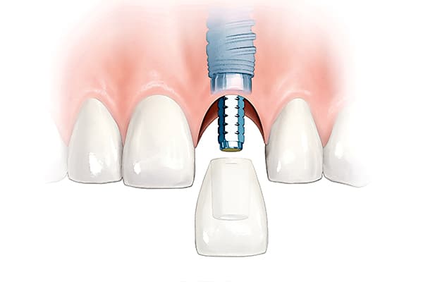Anterior Single tooth: Immediate Temporary illustration