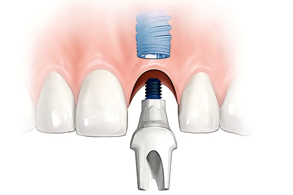 Anterior single tooth abutment  illustration