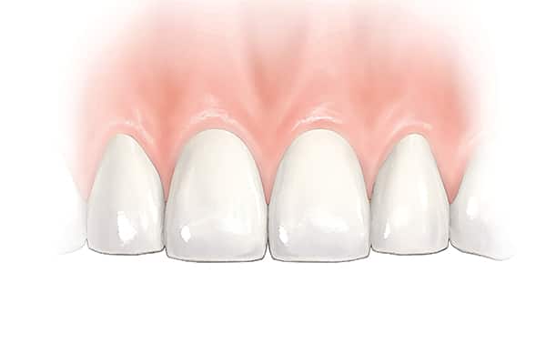 Anterior single tooth final  illustration