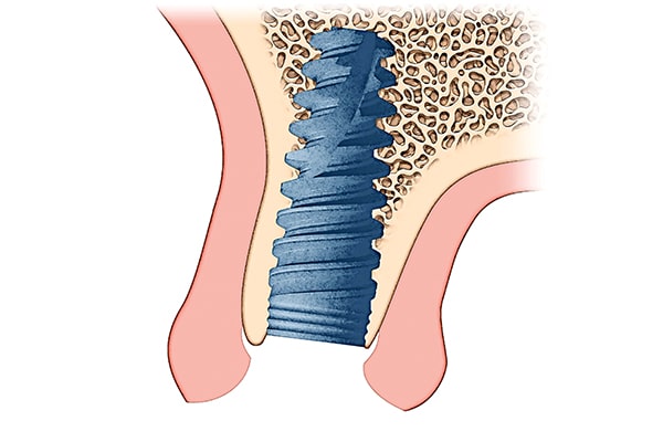 Implant placement uncovered implant illustration