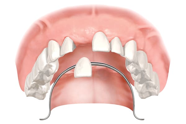 Partial Denture Illustration