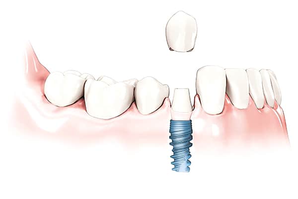 Single_Implant_Cemented_Crown illustration