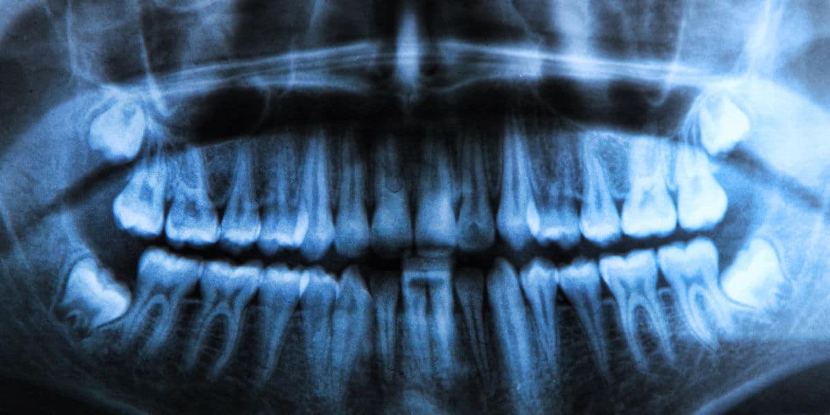 x-ray of a wisdom tooth extraction patient in Milwaukee WI
