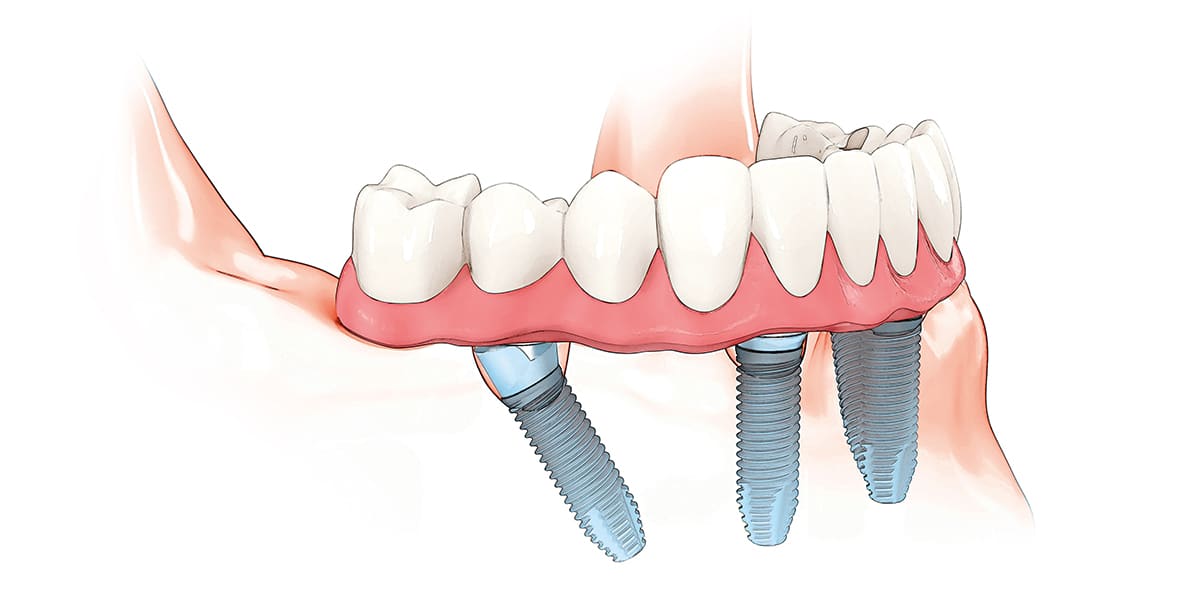 Implant Supported Dentures Graphic