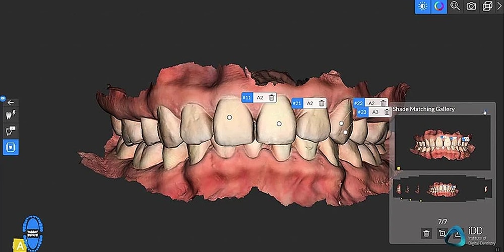 digital intraoral scans