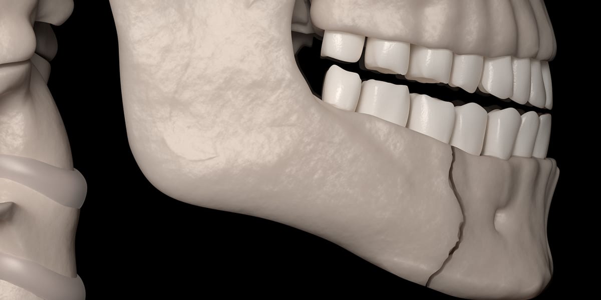 Illustration of a jaw fracture 